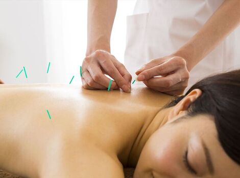背中前面に鍼を打たれた女性