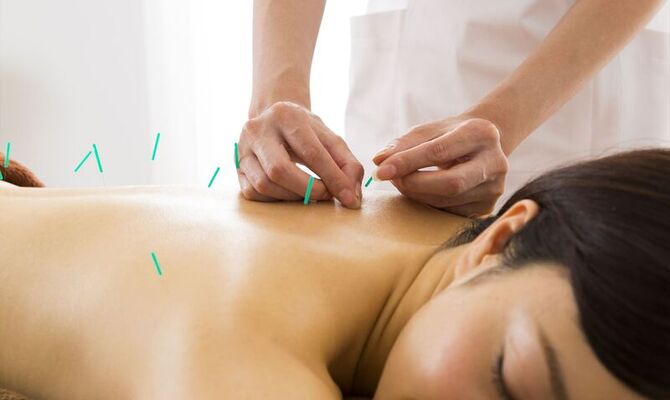 背中前面に鍼を打たれた女性